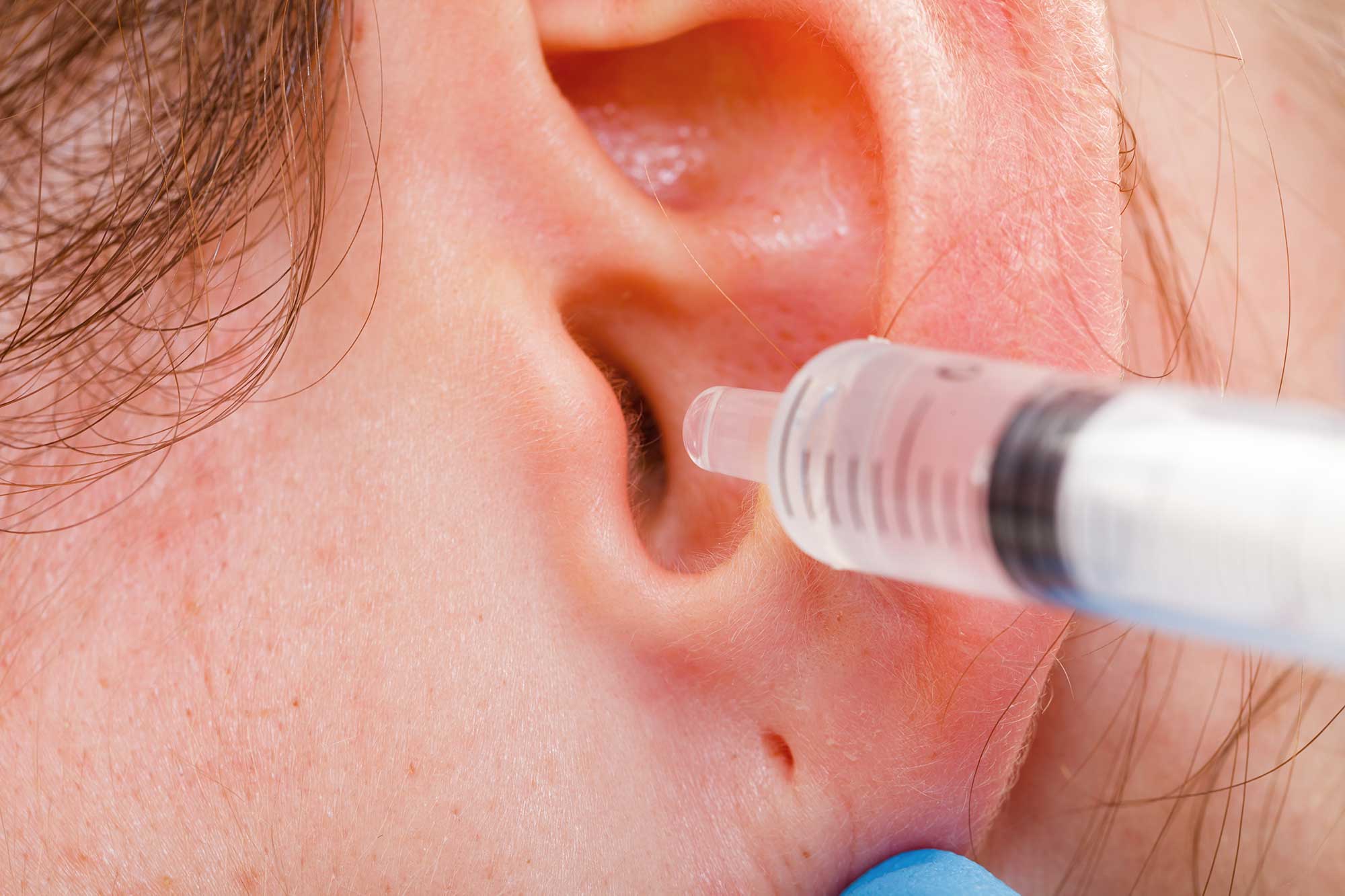 What is the Best Way to Clean My Ears?